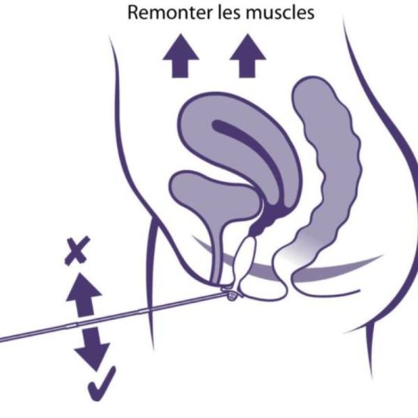 Sonde de rééducation périnéale - Periform+