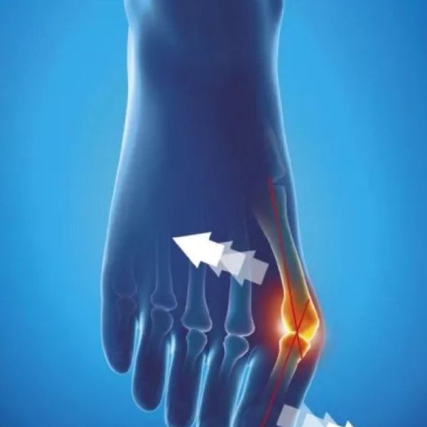 Orthèse corrective souple de jour - Hallux valgus